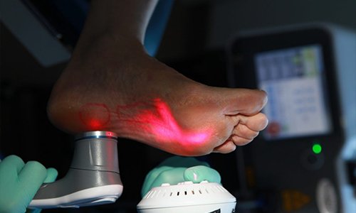 Laser Therapy for Chronic Foot and Ankle Pain